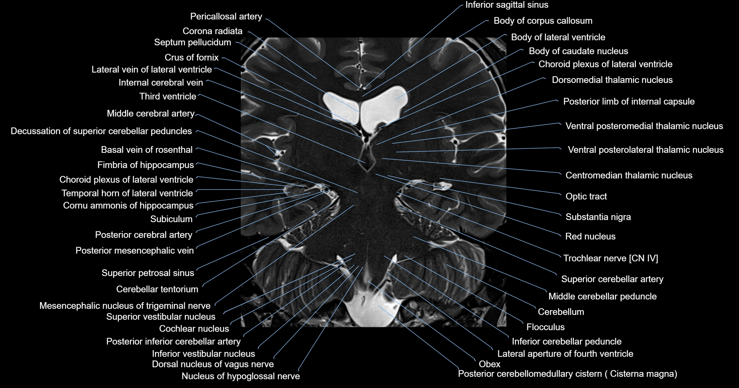 MRI brainstem & basal ganglia anatomy labelled 3T MRI images -img-00001-00025.webp